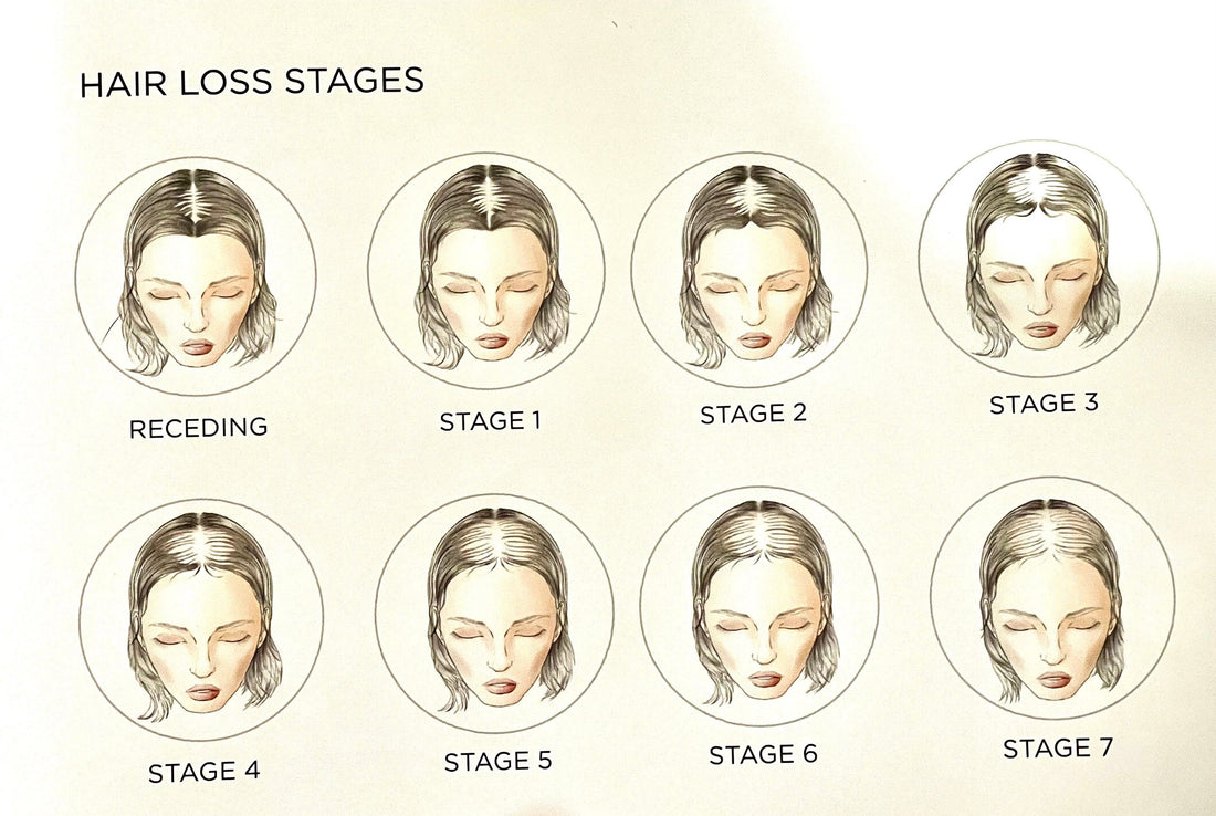 Stages of Hair Loss - Image Maker Wigs Online